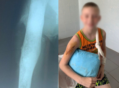 Травматологи Донецка смогли спасти 10-летнему мальчику руку с новообразованием 
