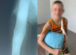 Травматологи Донецка смогли спасти 10-летнему мальчику руку с новообразованием 