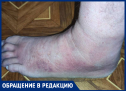 Хирург смотрел фотографию снимка рентгенограммы на телефоне: травмировавший ногу житель ДНР рассказал о ноу-хау в Старобешевской ЦРБ